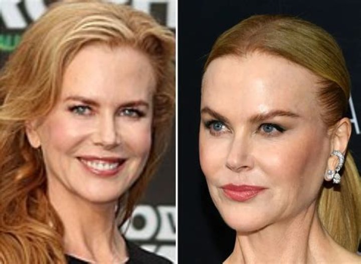 The Truth About Botox: Nicole Kidman's Experience
