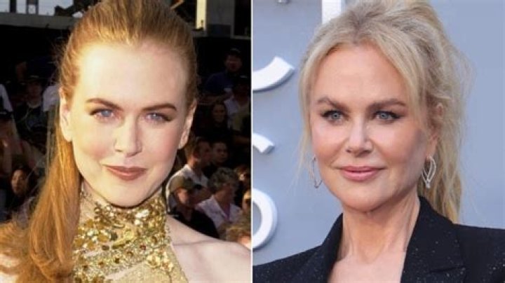 The Truth About Nicole Kidman's Plastic Surgery: A Comprehensive Guide