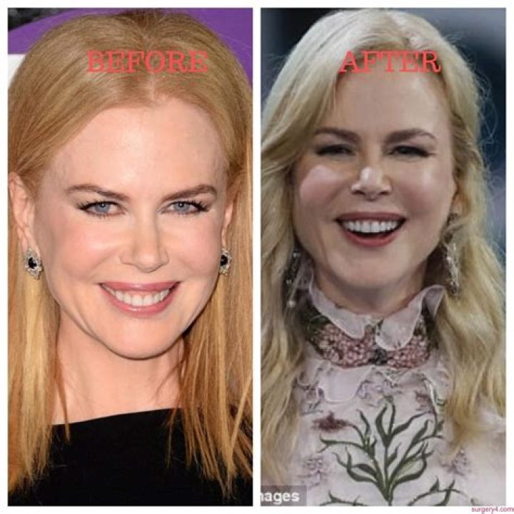 Unveiling Nicole Kidman's Plastic Surgery: Before And After